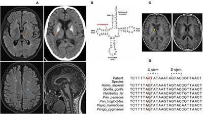 Multisystem Mitochondrial Disease Associated With a Mare m.10000G>A Mitochondrial tRNAGly (MT-TG) Variant